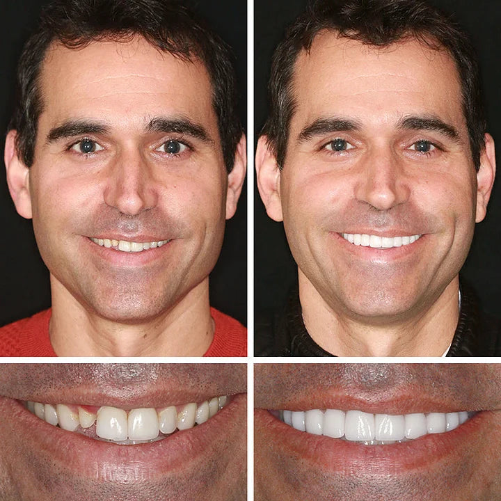 🏆 2026 Best Seller | Designed for Comfort and a Natural-Looking Smile & FDA-Certified
