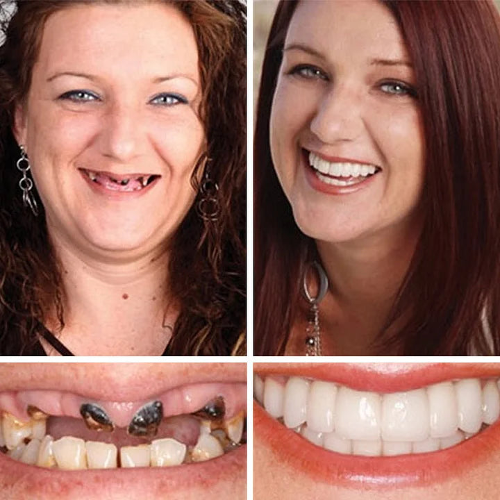 🌎Ends Today: 75% OFF! 🦷 Designed for Comfort and a Natural-Looking Smile